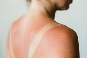 Das Bild zeigt den oberen Rücken und den Nacken einer Frau, auf dem einer starker Sonnenbrand ist. Lediglich die Hautstelle, die von einem Bikiniträger geschützt wurde, ist nicht verbrannt. 