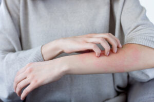 Auf der Abbildung ist der Unterarm einer Frau zu sehen, der an einer Stelle stark gerötet ist. Mit ihrer anderen Hand kratzt sie sich die juckende Hautstelle. 