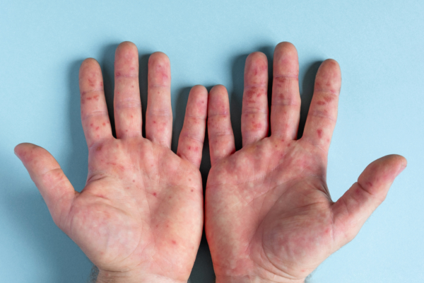 Das Bild zeigt die Innenseiten von Händen, die die typischen roten Flecken der Hand-Mund-Fuß Krankheit aufweisen. 