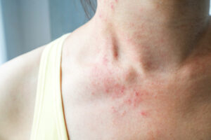 Das Bild zeigt einen Ausschnitt des Hals und des Dekolletés einer Frau, die von einem Hautpilz befallen sind. 