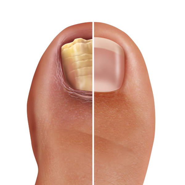 Das Bild zeigt einen Fußnagel, der auf der einen Seite infiziert ist und die andere ist gesund. 