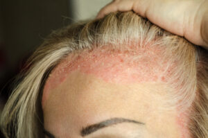 Das Bild zeigt den Haaransatz einer Frau mit einem seborrhoischem Ekzem.