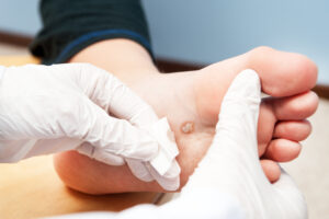 Das Bild zeigt die Fußsohle einer Person mit einer Warze, die von einem Arzt oder Ärztin behandelt wird. 