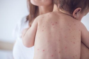 Das Bild zeigt eine Frau, die ein Kind mit Windpocken auf dem Arm hält. Man sieht den Rücken des Kindes, auf dem die typischen roten Punkte der Windpocken zu sehen sind. 