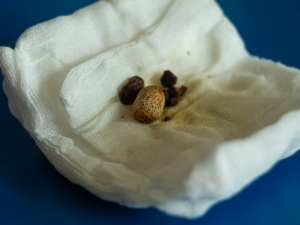 Das Bild zeigt mehrere kleinere und größere Gallensteine, die auf einer weißen Mullbinde liegen. 