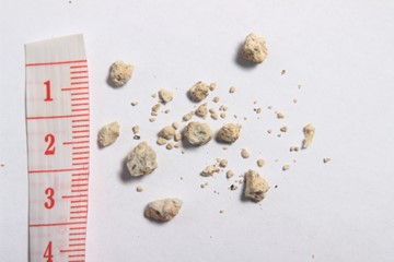 Auf dem Foto sind kleine bis mittelgroße Nierensteine zu sehen, die neben einem Maßband liegen. Der größte Stein ist 50 Millimeter groß.
