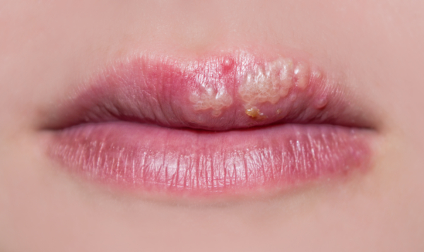 Die Abbildung zeigt einen Mund mit Lippenherpes an der oberen Lippe.