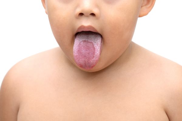 Ein kleines Kind streckt seine Zunge heraus, die mit Mundsoor befallen ist. 