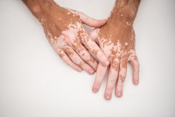 Das Bild zeigt Hände einer Person, die an Vitiligo erkrankt ist. 