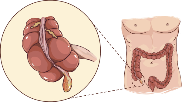 Das Bild zeigt eine Grafik des Darms sowie eine hervorgehobene Grafik des Wurmfortsatzes.