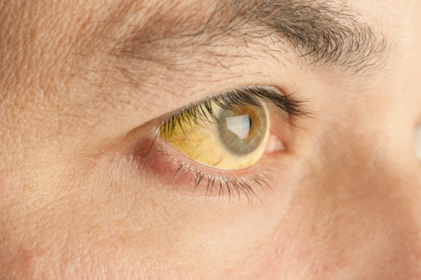 Das Bild zeigt ein gelblich verfärbtes Auge aufgrund von Gelbsucht.
