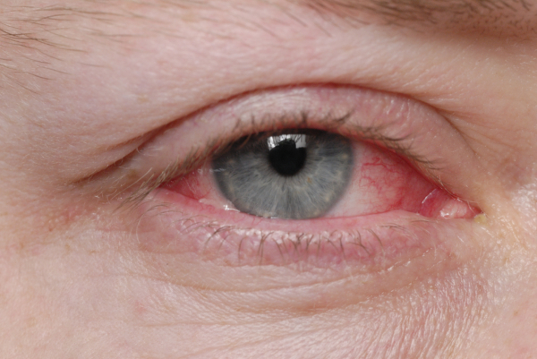 Das Bild zeigt ein Auge mit einer Bindehautentzündung. 