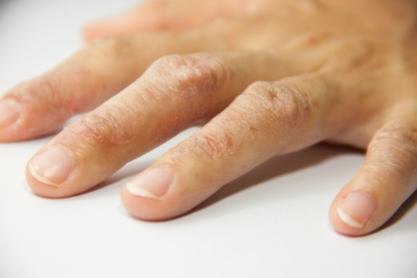 Das Bild zeigt eine Hand mit Rötungen aufgrund einer Latexallergie. 