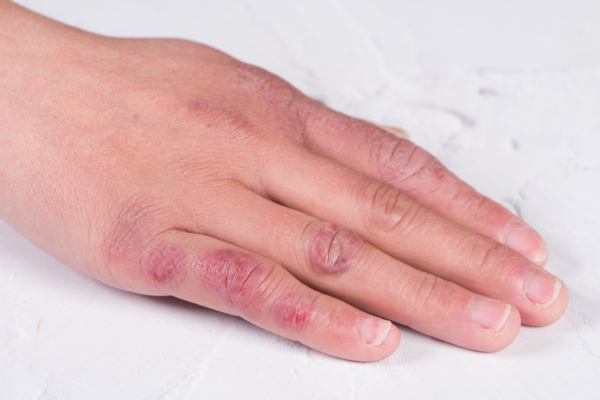 Das Bild zeigt eine menschliche Hand mit Frostbeulen.